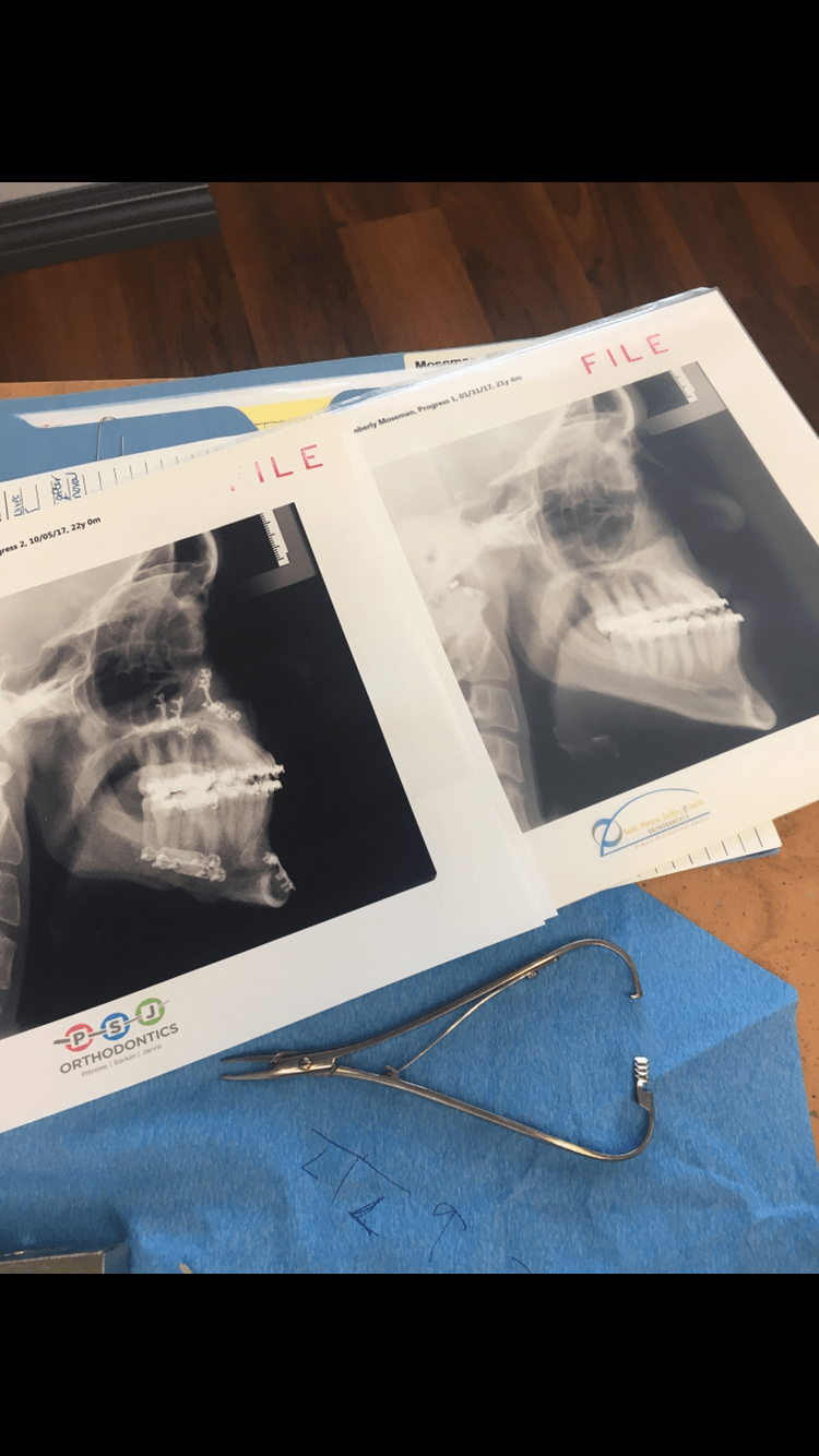 Jaw Surgery FAQ kimbermoose