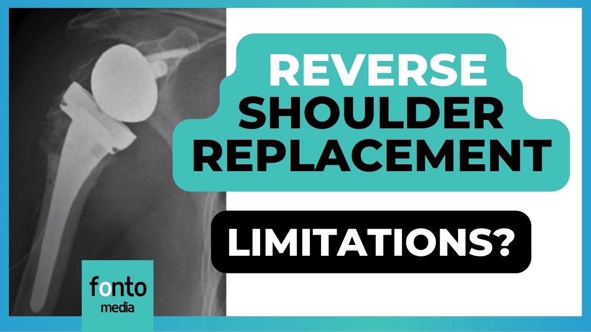 What are the limitations after reverse shoulder replacement