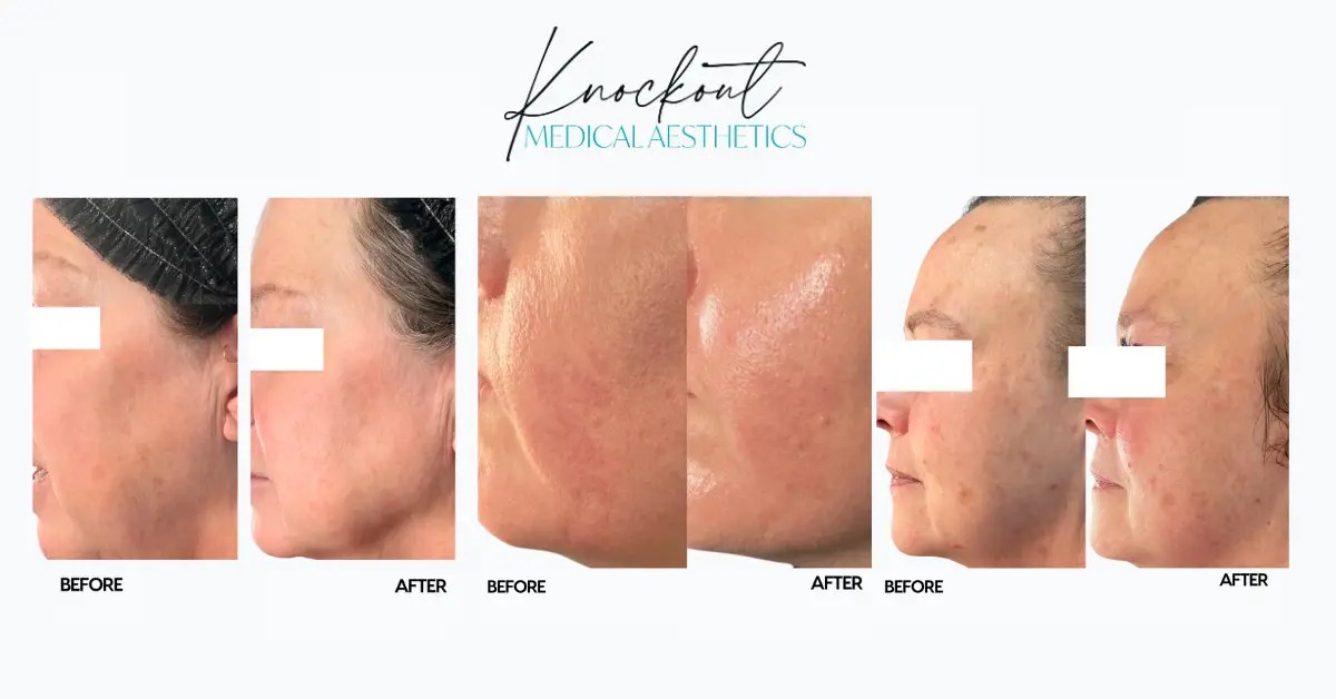 Laser vein treatment: what it treats (and what it doesn’t)