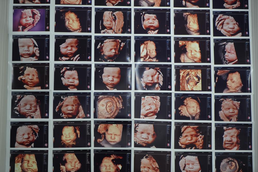 Tüp bebek tedavisinde kişiye özel protokol başarıyı artırıyor