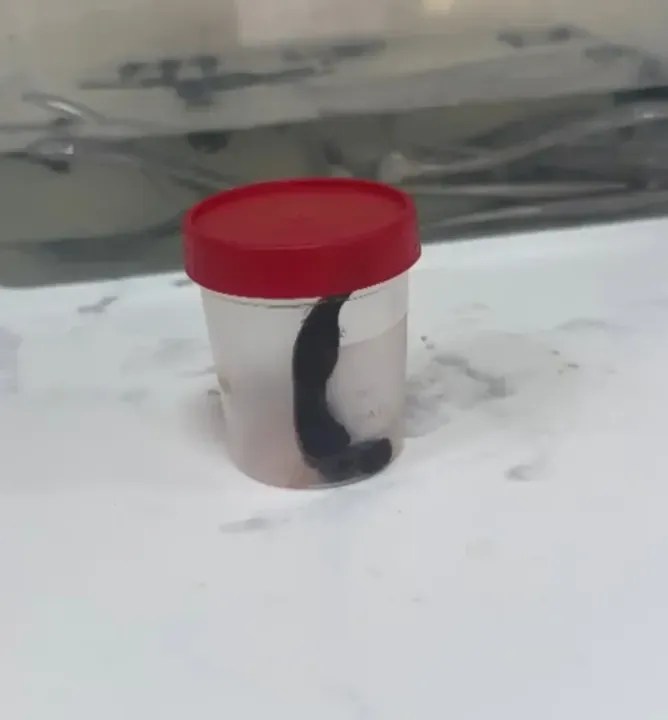 Çocuğun boğazından sülük çıkarıldı!