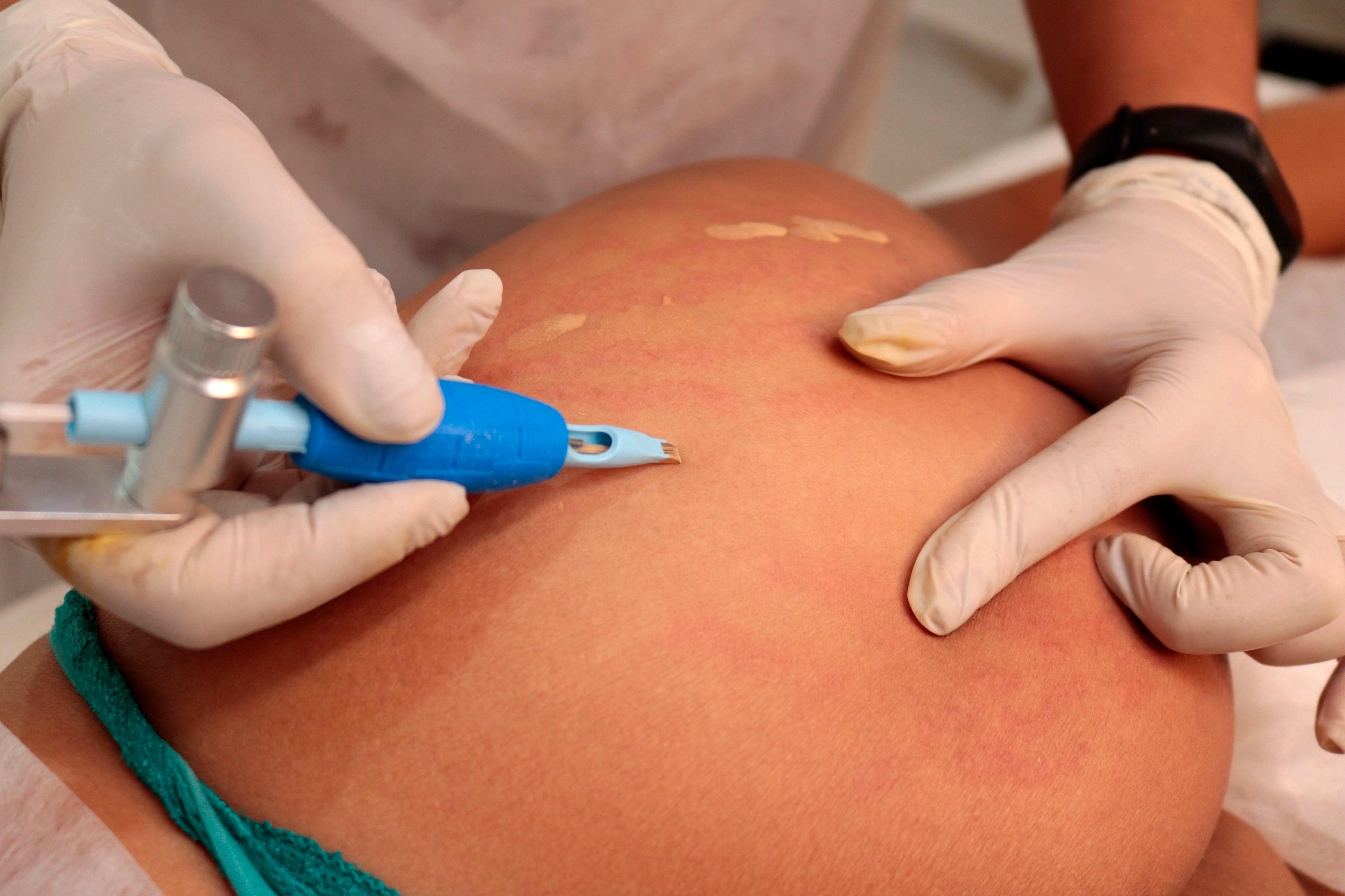 Camuflagem de estrias com micropigmentacao ou tatuagem Camuflagem De Estrias E A Mais Nova Tendencia De Estetica Obs Feminino Ou Masculino A Micropigmentacao Age Aplicando Uma Tintura Com O Objetivo De Cobri La Como Se Fosse Uma Tatuagem