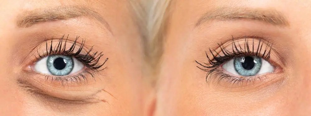 How to Get Rid of Extra Skin Under Eyes