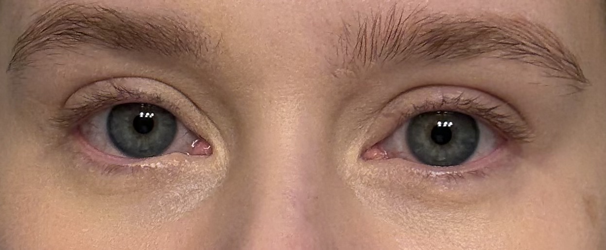 How to Find Your Undereye Bags and Actually Do Something About Them
