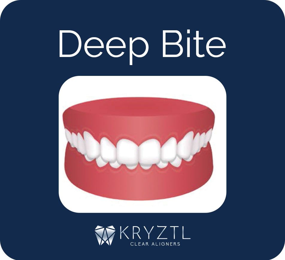 deep-bite