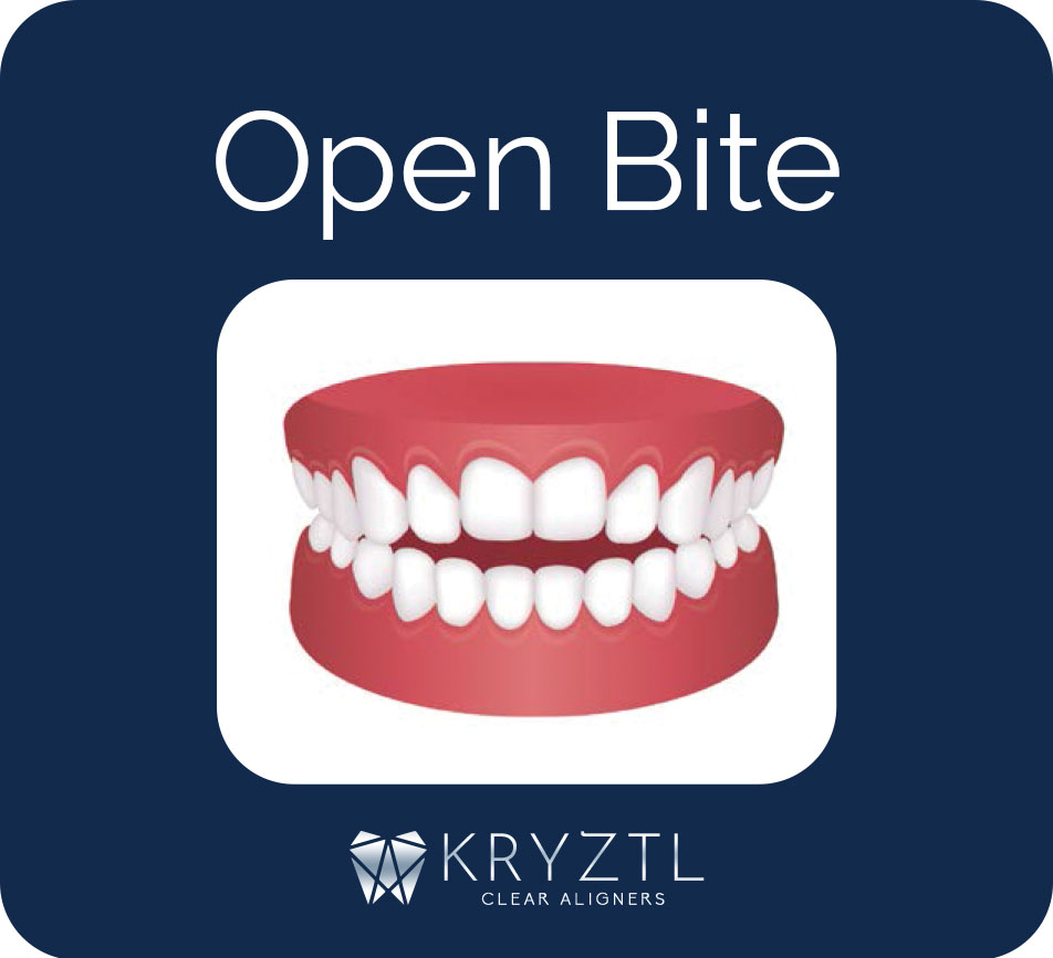 open-bite