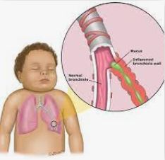 Cases Of RSV Surging At Mexico Urgent Care Clinic
