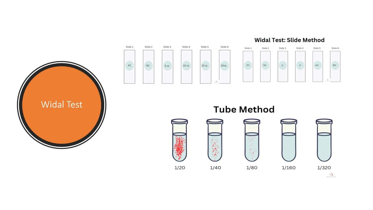 Widal Test Procedure, Principle, and Results