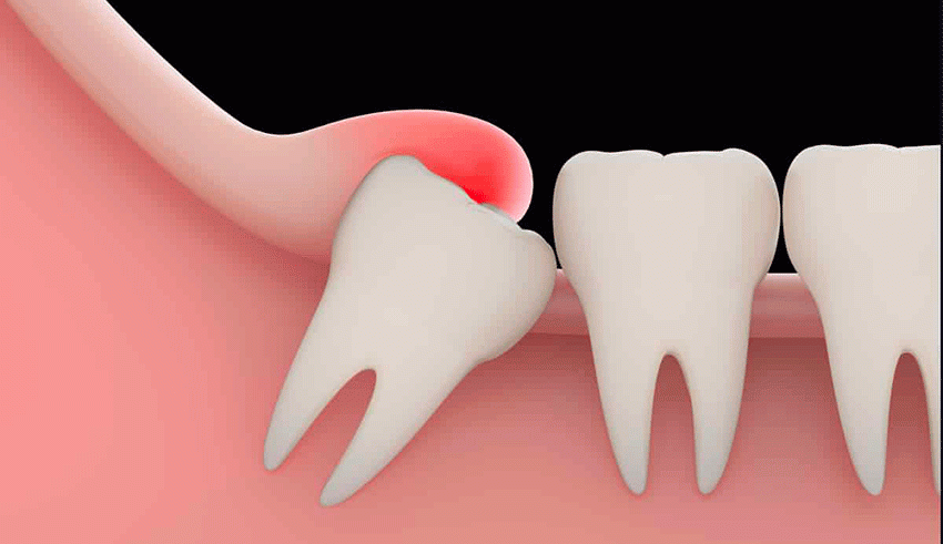 Dents de sagesse