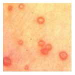 Molluscum Contagiosum Traitement Naturel Traitement Homeopathique