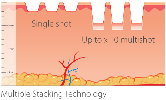 Erbium Fractional