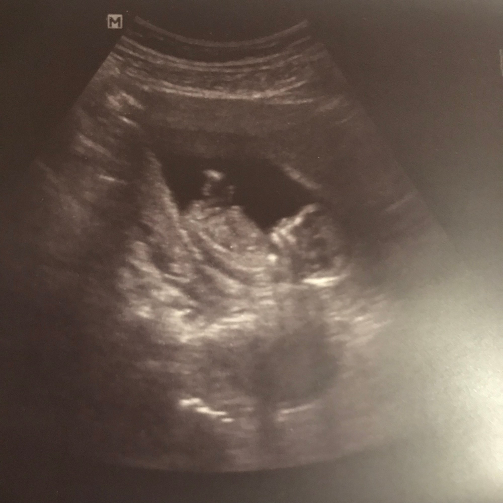 First Trimester Bumpdate