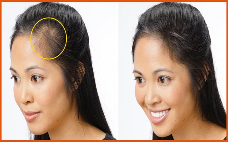 Lace Frontal Balding: The Well-Rounded Solution For Baldness