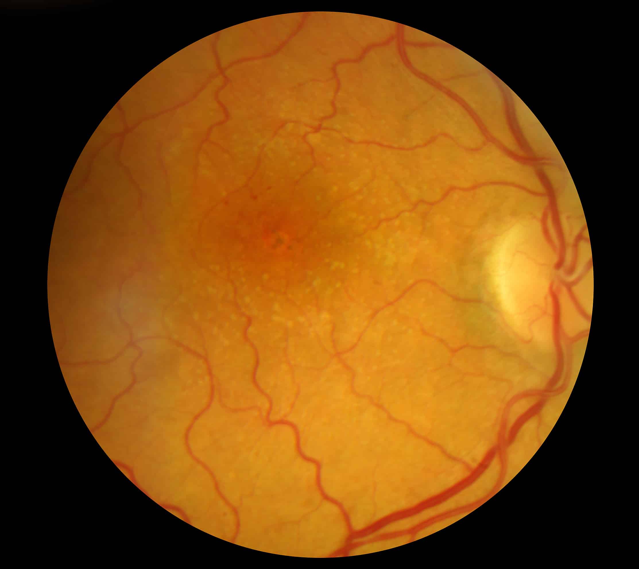 Age-related macular degeneration (AMD) - Legarreta Eye Care