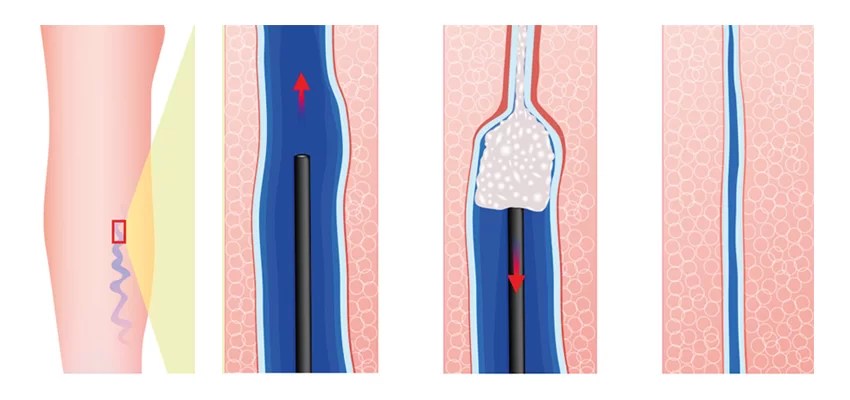 Imagem ilustrativa da aplicação de espuma nas pernas de um paciente.