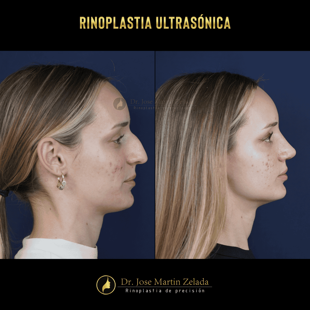 RINOPLASTIA ULTRASONICA