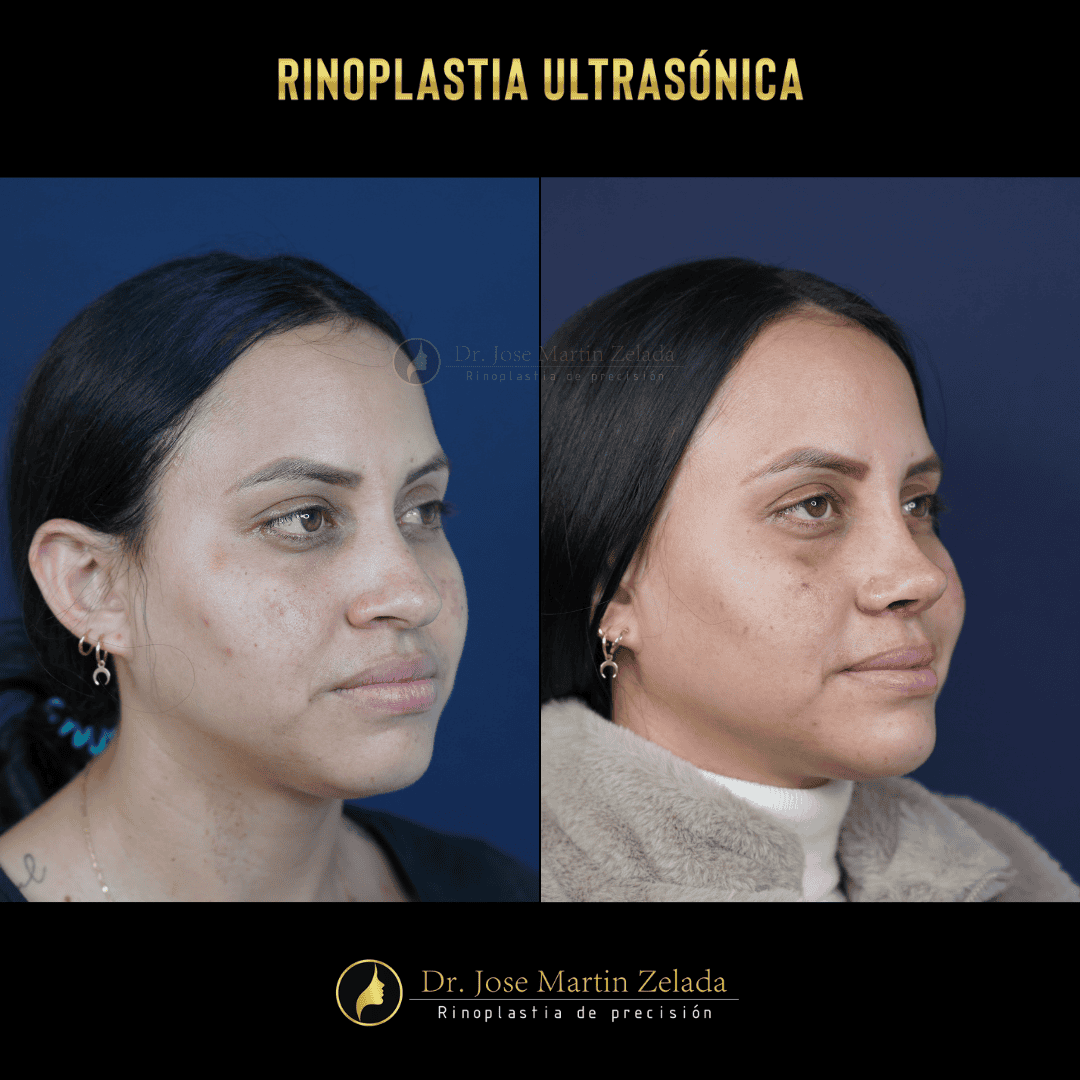 RINOPLASTIA ULTRASONICA