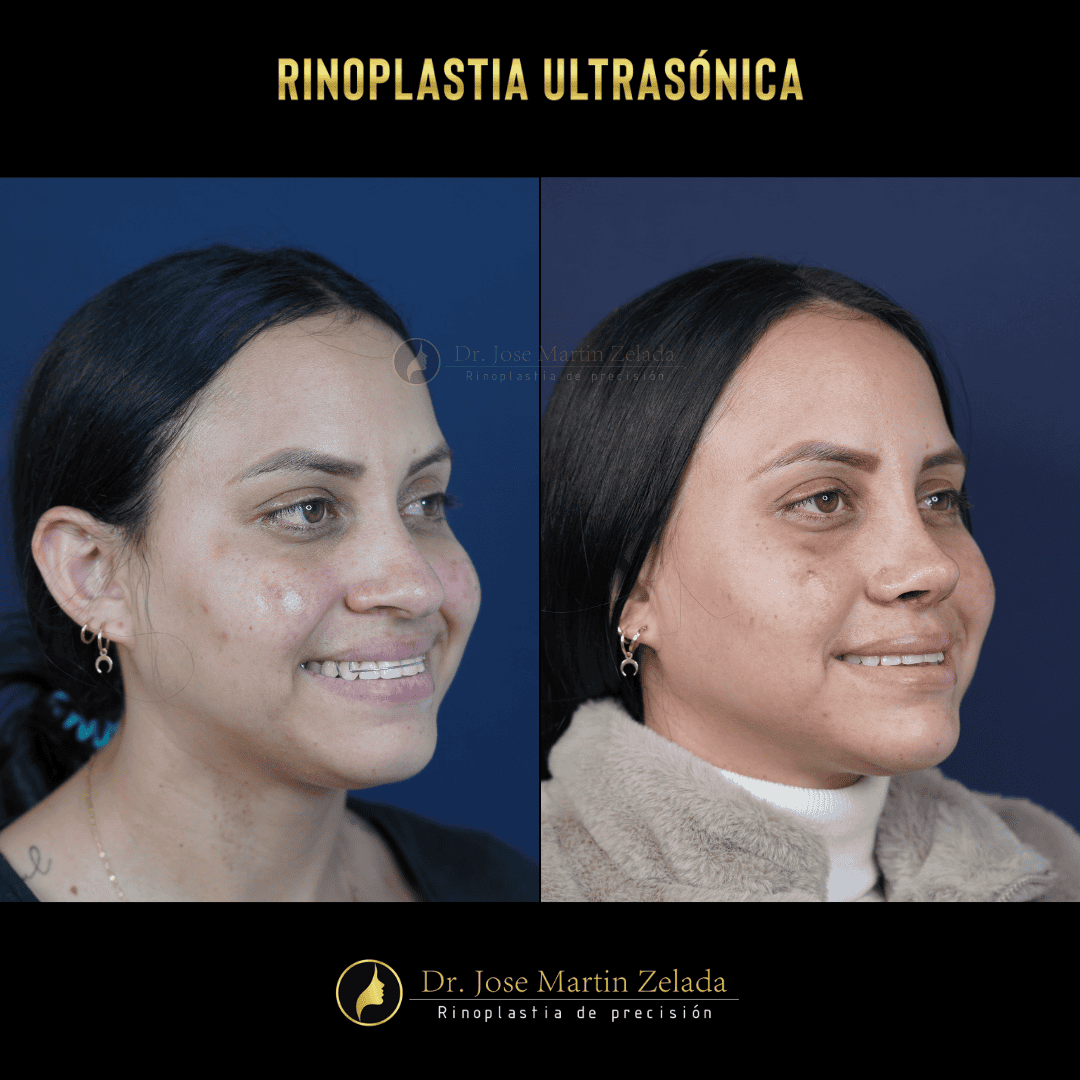 RINOPLASTIA ULTRASONICA