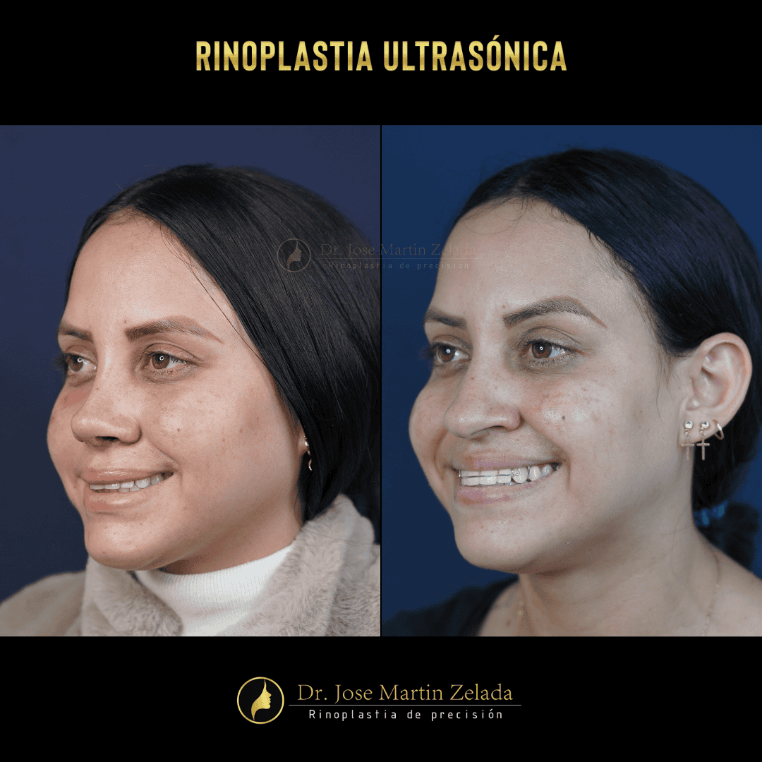 RINOPLASTIA ULTRASONICA