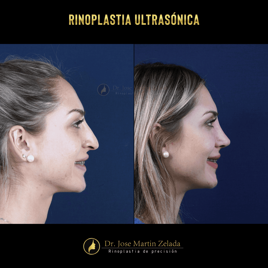 RINOPLASTIA ULTRASONICA