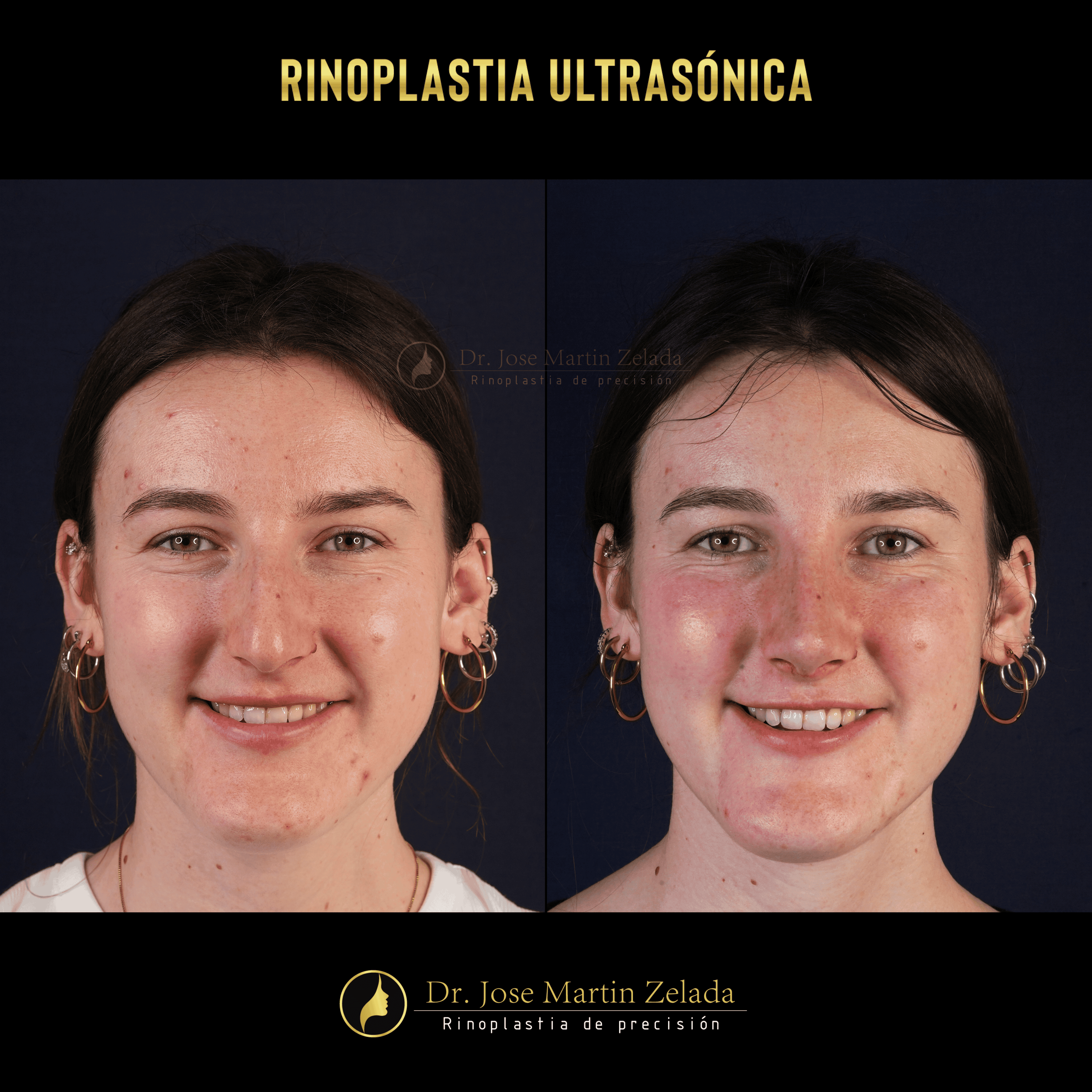 RINOPLASTIA ULTRASONICA