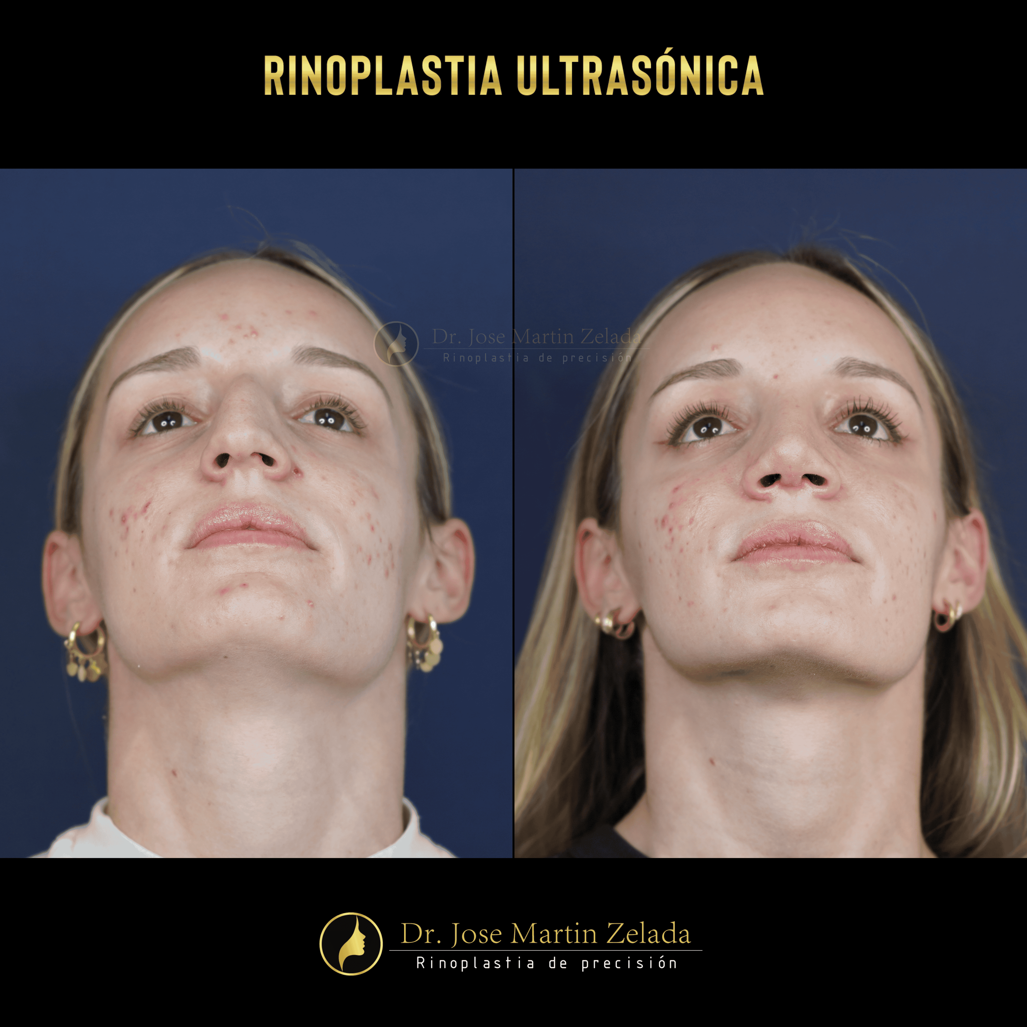 RINOPLASTIA ULTRASONICA
