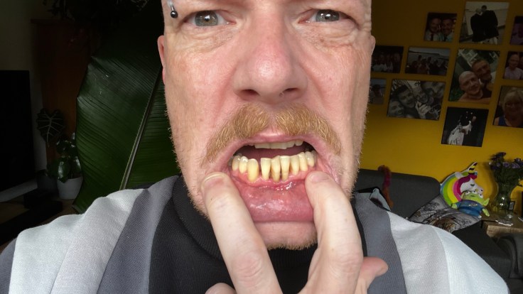 Photo of the damaged teeth, which are squint, gapped and yellow