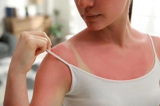 heal a sunburn, treat a sunburn