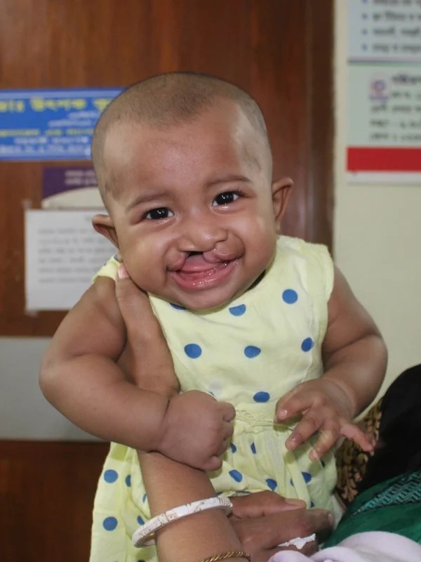 Free cleft surgery
