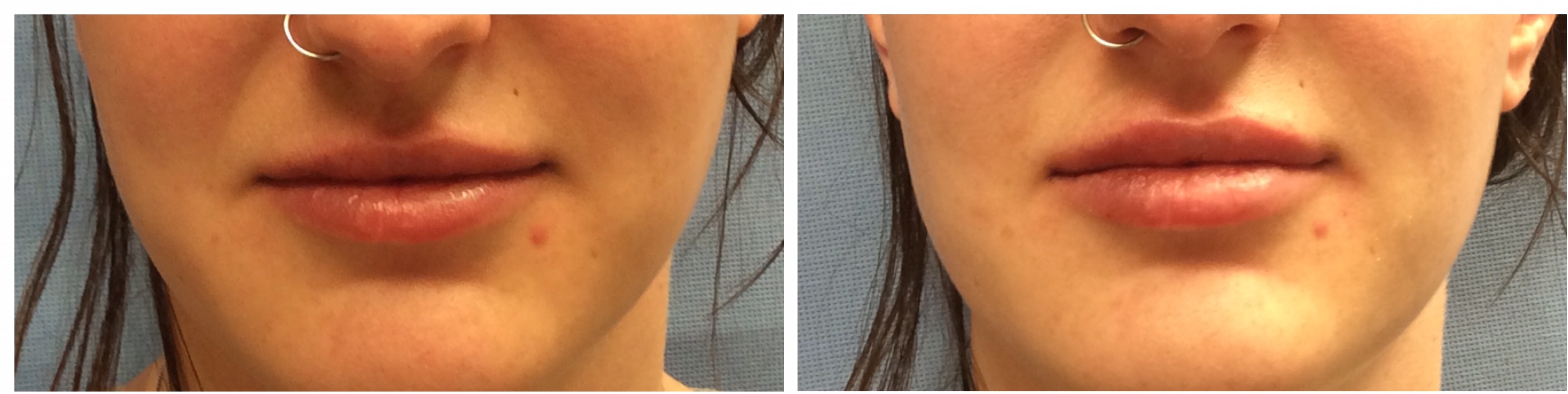 Locate the philtrum, which forms a distinct groove on the midline between the root of the nose and the margin of the upper lip. Lisa Bunin Md Lip Enhancement Before After Pictures Lisa Bunin Md