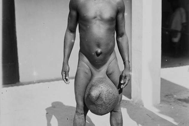 Elephantiasis