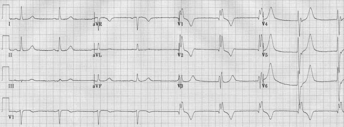 • qrs > 0.12 seconds • slurred s in i and v6 • rsr' or notched r in v1 ucsd internal … Rbbb Ecg Images