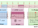 Ecg Rate Interpretation Litfl Medical Blog Ecg Library Basics