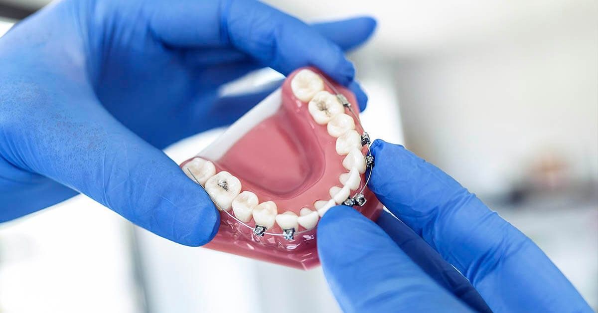 Retrait des bagues 🦷