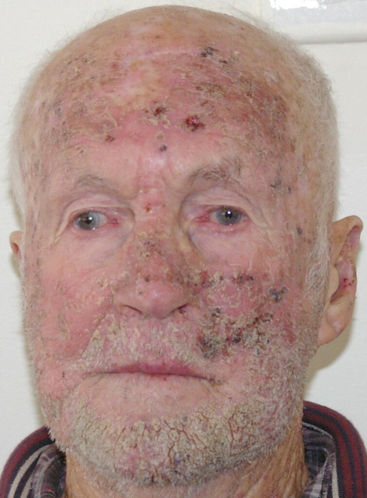 If you aren't sure which type of skin cancer. Concerns Raised Over Ala Skin Cancer Cream As Patients Recount Horrendous Pain Abc News