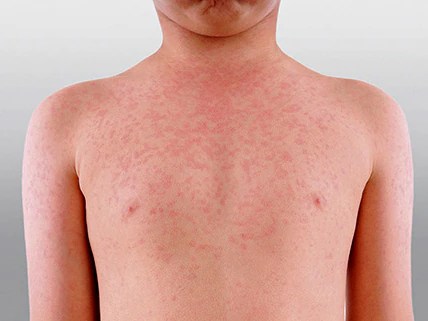 Measles Outbreak Risk: 1.7 Million Australians Vulnerable | Immunization Gaps (2026)