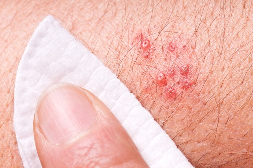 Doctors divided over worldwide surge in shingles (2026)