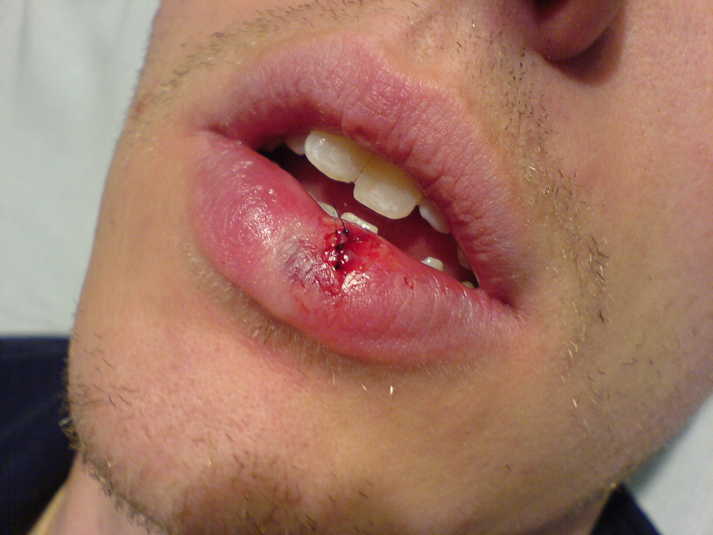 Is still bleeding after you apply pressure for 5 minutes · is gaping or wide · looks deep · is on your child's face, lips, or neck · has glass or other debris in it . Grafting The Lip Three Stitches And Four Hours Later I Le Flickr