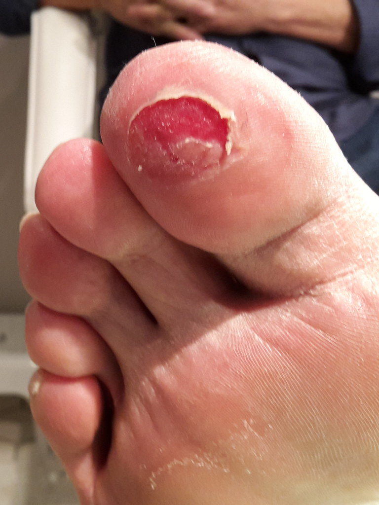 Bei 50 prozent der patienten neuropathie; Patient Met Dropfoot En Sensibele Neuropathie Door Cauda E Flickr