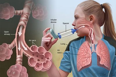 Inhaler albuterol generik mengandung cfc yang dilarang sehingga digantikan dengan inhaler yang menggunakan hydrofluoroalkane (hfa) yang . Obat Asma Di Apotik Idah Rosidah Flickr