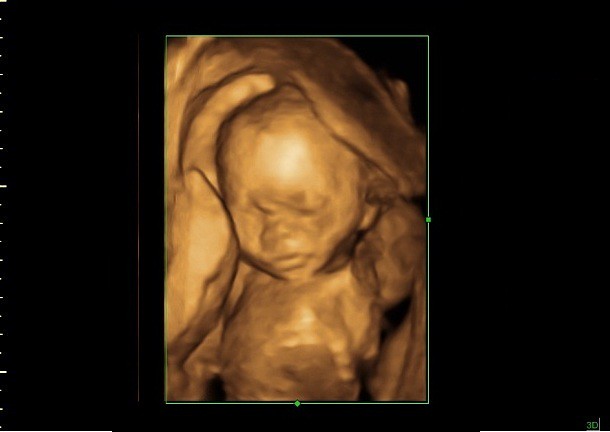 20 weeks baby in 3d ultrasound