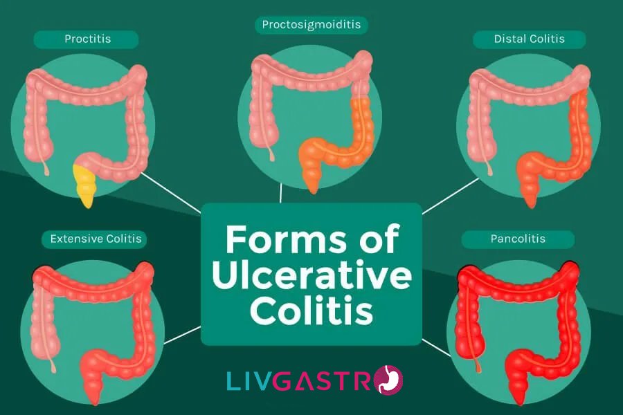 Ultimate guide to colitis: types, causes, symptoms & treatment
