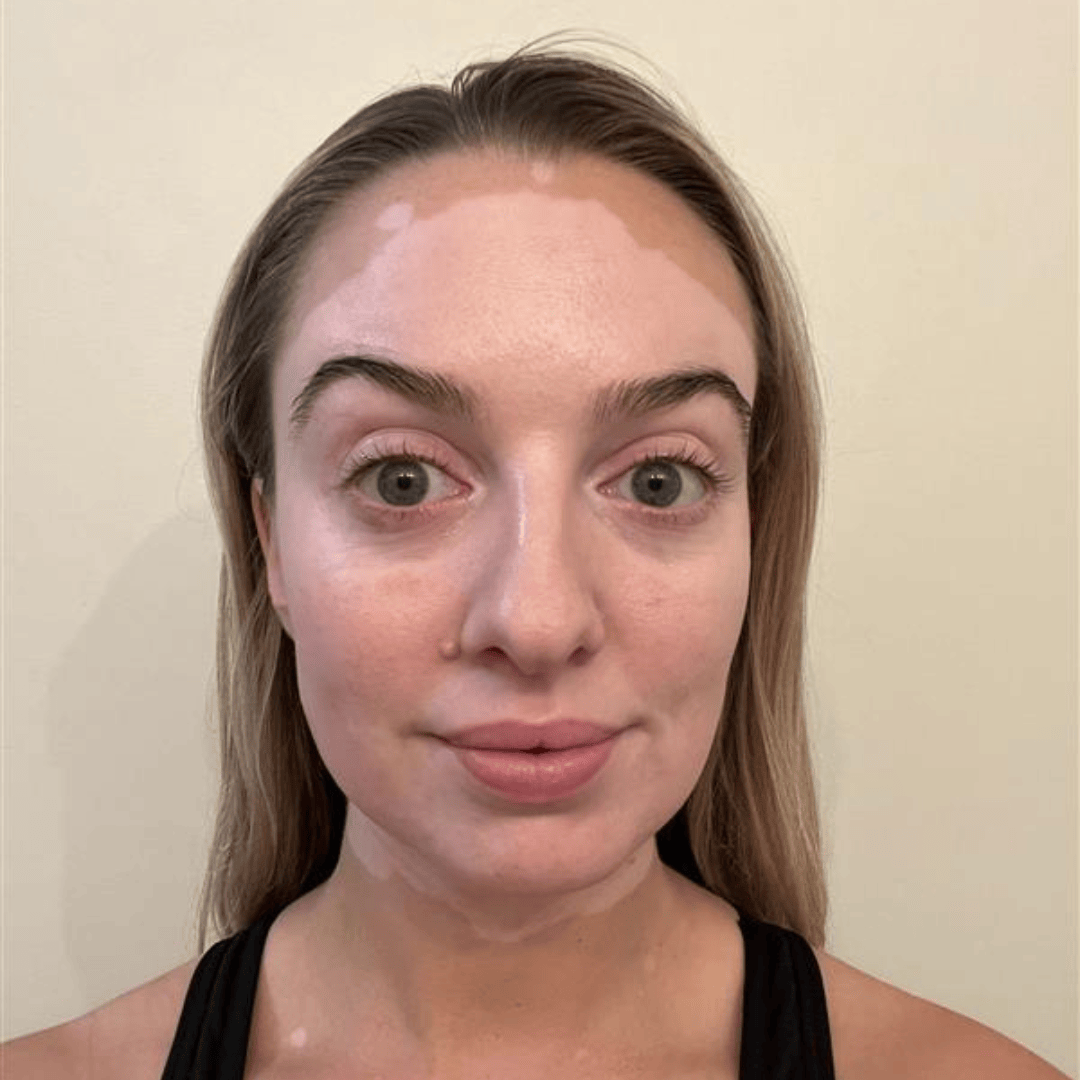 A photo of Sam, a woman with light skin and brown hair, showing areas of depigmentation on her forehead and around her eyes due to nonsegmental vitiligo. Photo taken prior to treatment with OPZELURA.