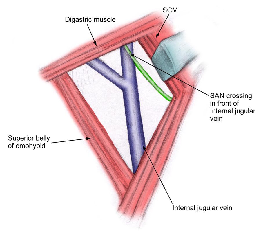 Spinal accessory nerve (SAN) posterior to the internal jugular vein [Medscape]