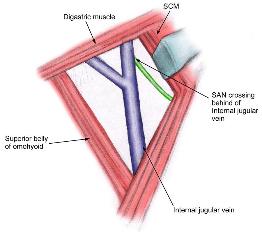 Relationship of internal jugular vein to the spinal accessory nerve (SAN) [Medscape]