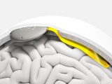 Precision Neuroscience Lands 102m To Advance Ai Powered Brain Implant
