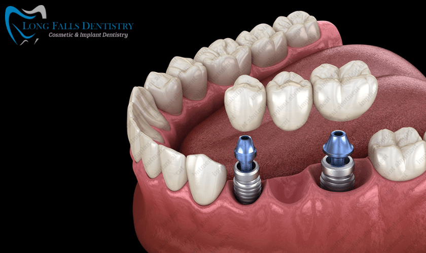 Everything you need to know about abutment teeth