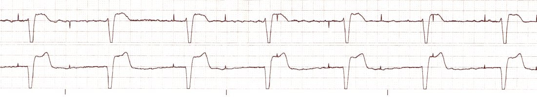 Pacer Not Capture Example EKG of the Week #1 | Lost on the Floor