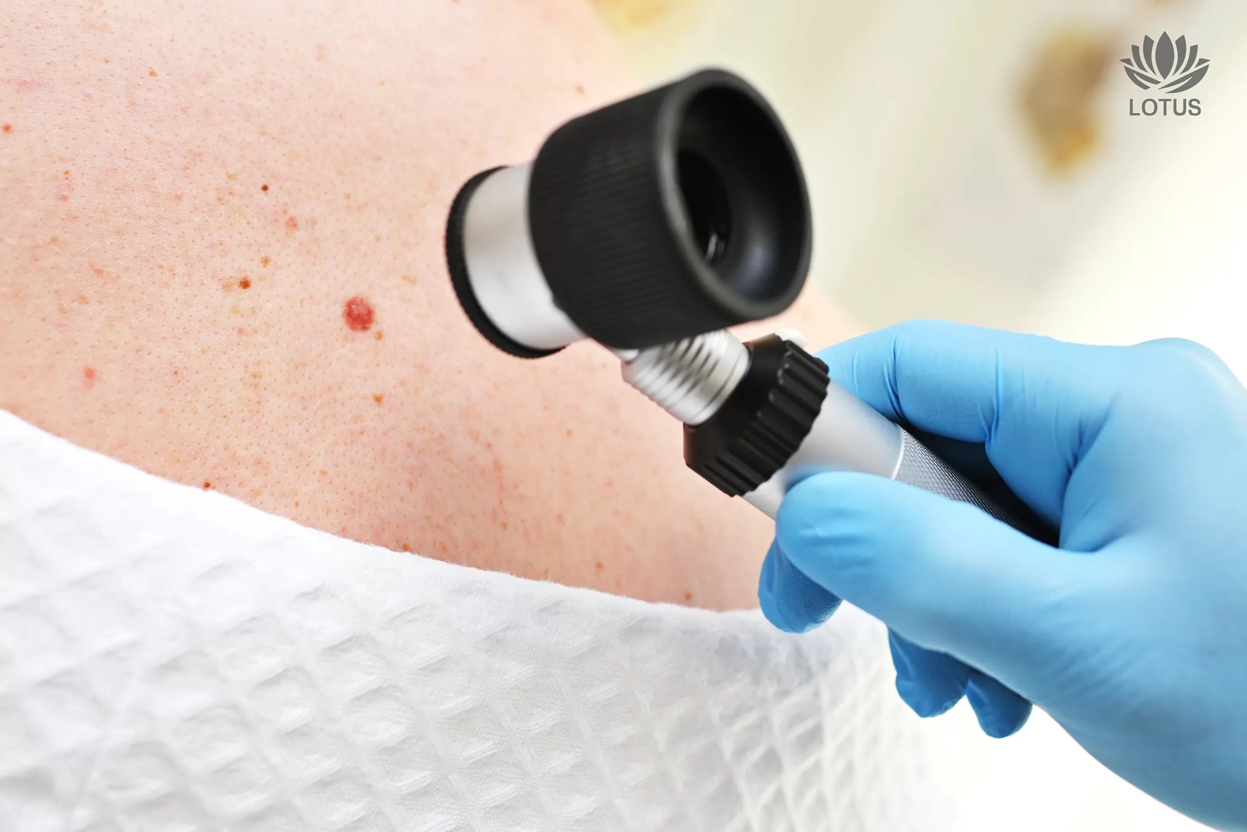 Prevención del Cáncer de Piel en San Leandro | Cuidado de la Piel / Skin Cancer Prevention in San Leandro | Skin Care