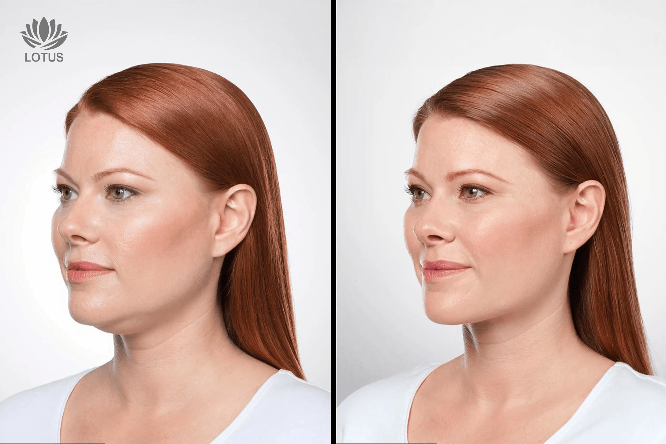 Kybella para eliminar la papada sin cirugía en San Leandro